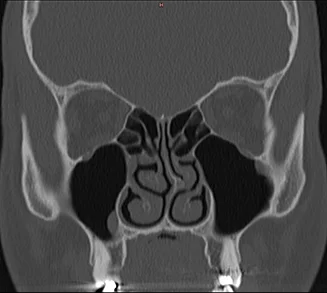 CT-Scan einer Nasenhöhle und der Nasennebenhöhlen in frontaler Ansicht.